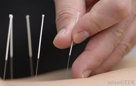 accupunctureimage